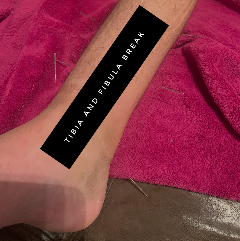 Tibia and Fibula Break Tibia and Fibula Break